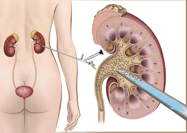  Urology Surgery
