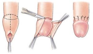  Urology Surgery